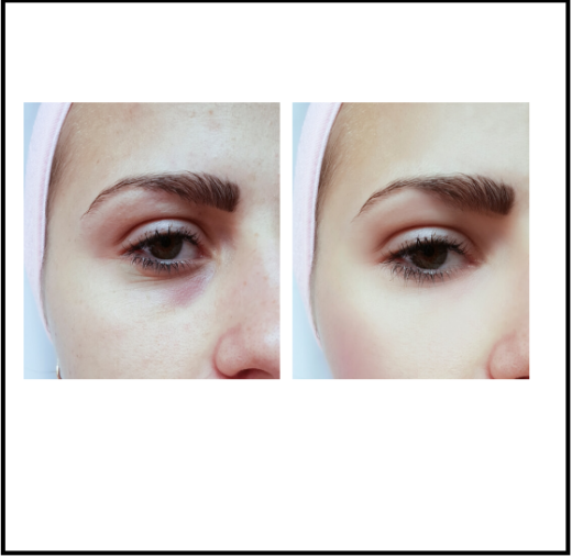 GÖZ ALTI MORLUKLARI