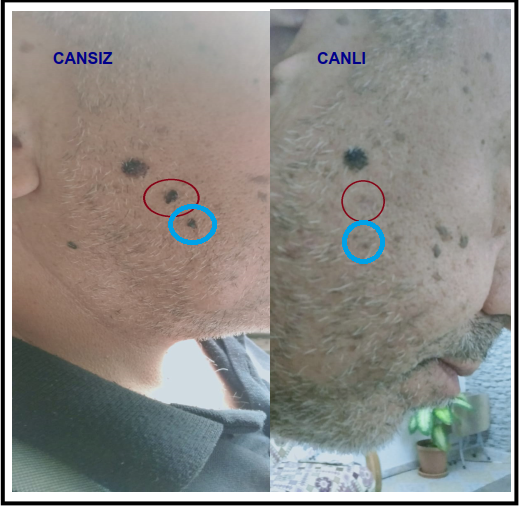 BEN ve SİĞİL TEDAVİSİ (LAZER İLE)